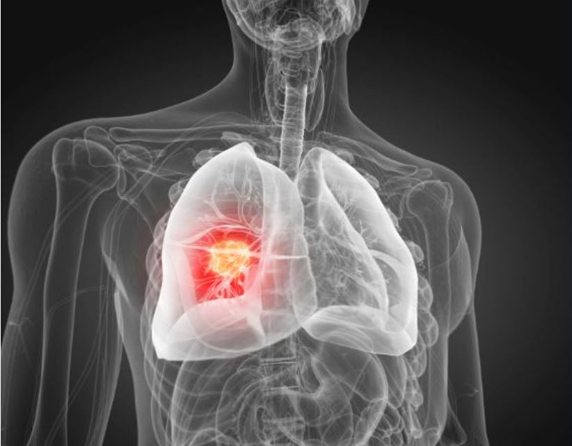 La US estudiará con IA las causas de la alta incidencia de cáncer de pulmón en Sevilla, Cádiz y Huelva