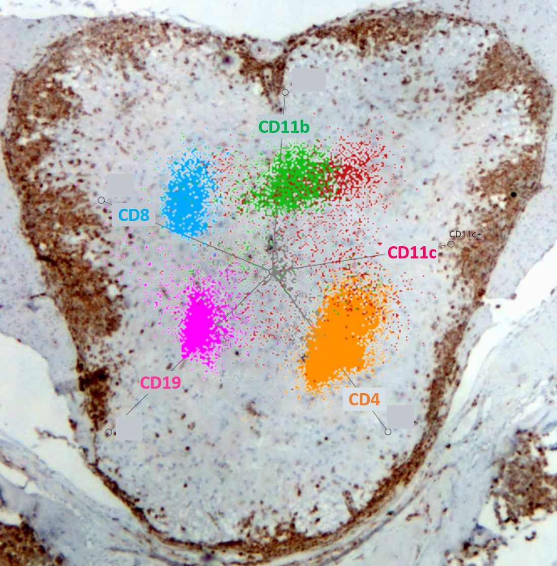 La melatonina podría reducir la dosis de corticoides en el tratamiento de la esclerosis múltiple