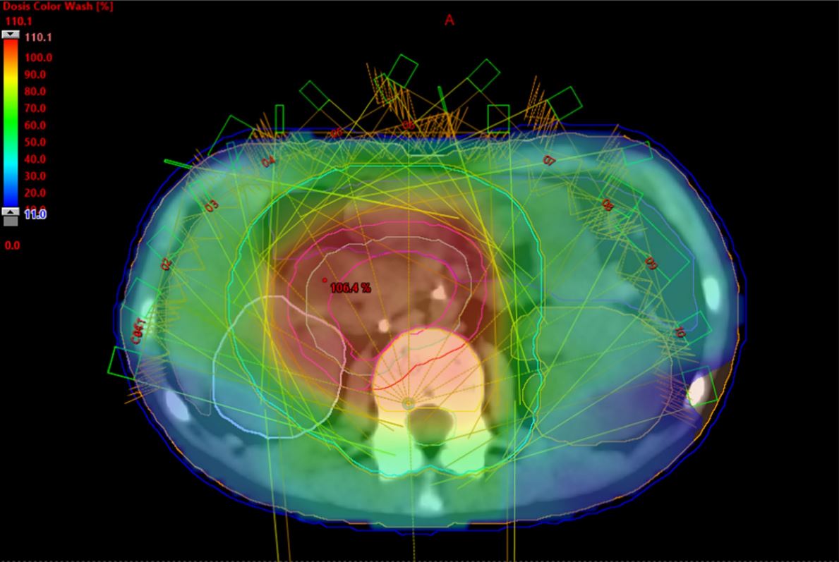 Una investigación de la US permite predecir recaídas en pacientes de cáncer infantil
