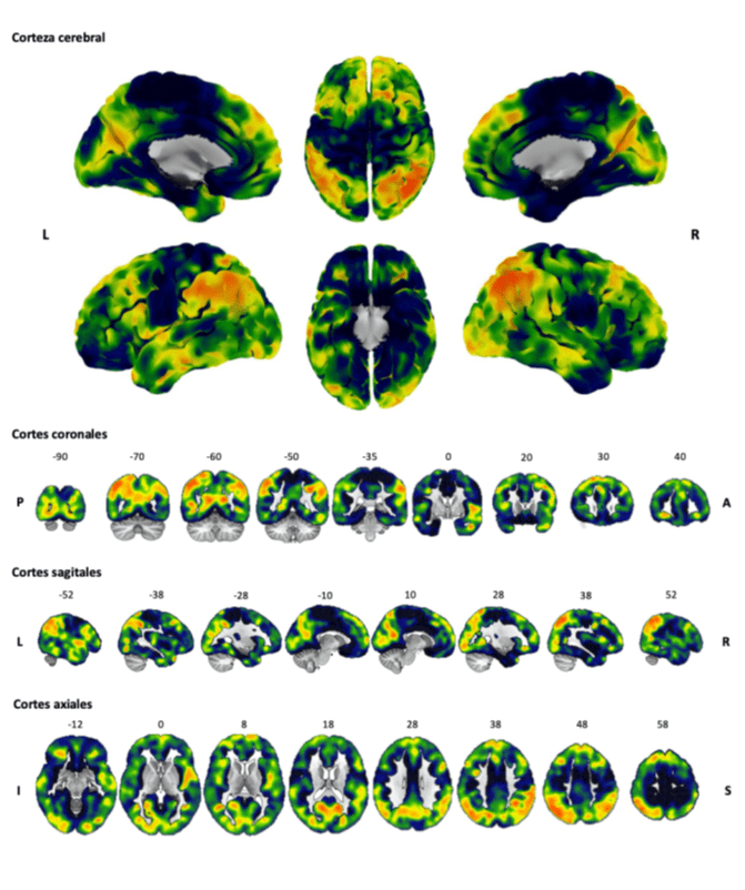 Nuevos factores implicados en el deterioro cognitivo y la demencia asociada al Parkinson