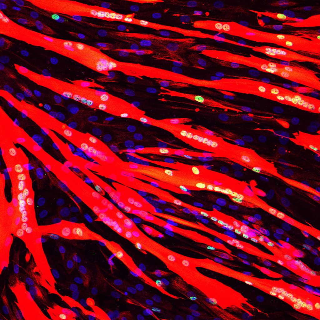 Una iniciativa pública de 3,9M€ reunirá a los mayores expertos de ELA para impulsar la investigación