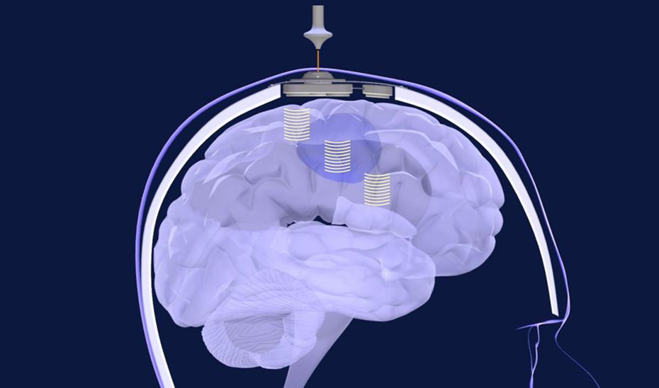 Andalucía participa en un ensayo pionero contra el glioblastoma, un tipo de tumor cerebral
