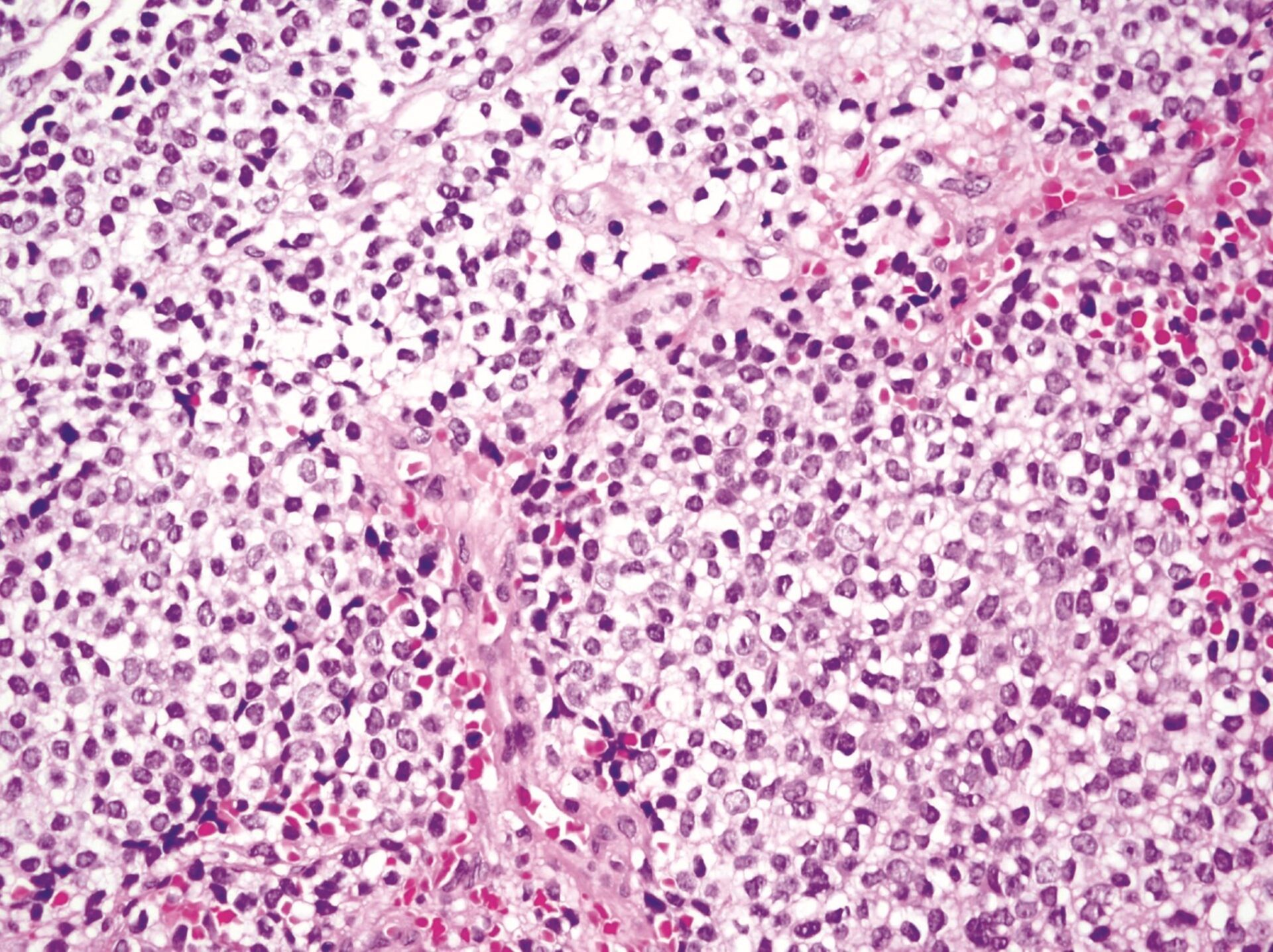 Un estudio del IBiS desvela un nuevo mecanismo de sensibilidad del sarcoma de Ewing a la quimioterapia